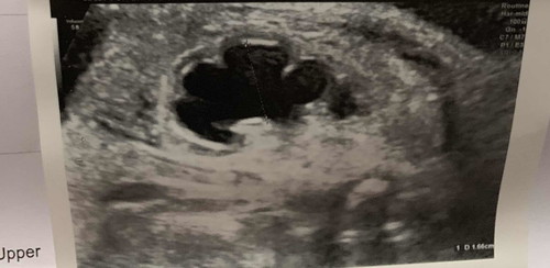 ถุงน้ำในไตน้อง ตอนอยู่ในครรภ์