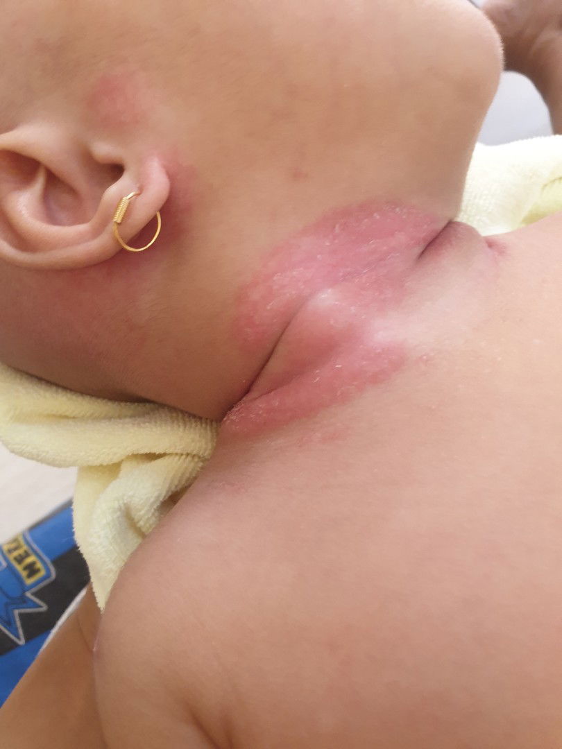 merah2 pada leher & bagian lipatan.