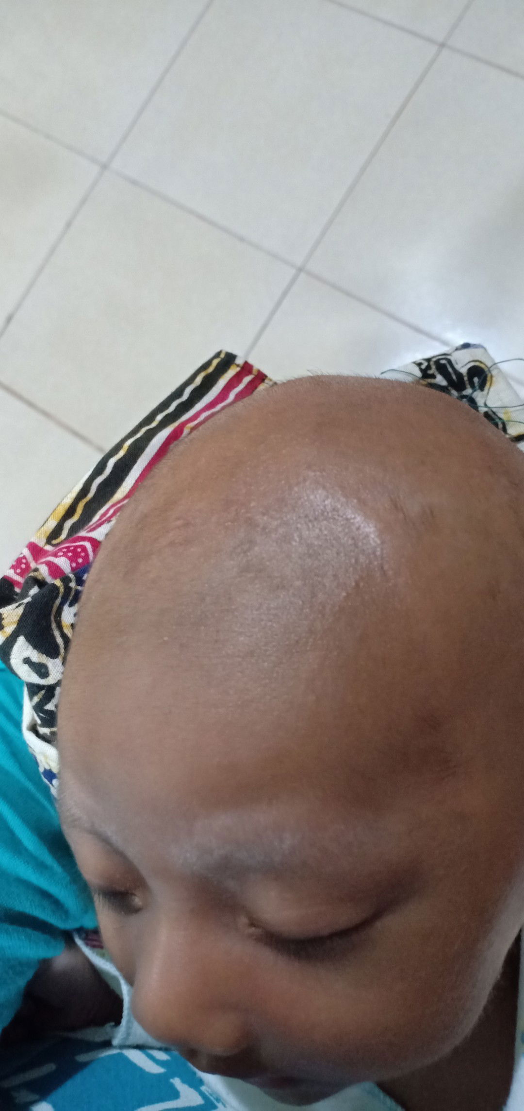 kepala bayi bagian depan cekung