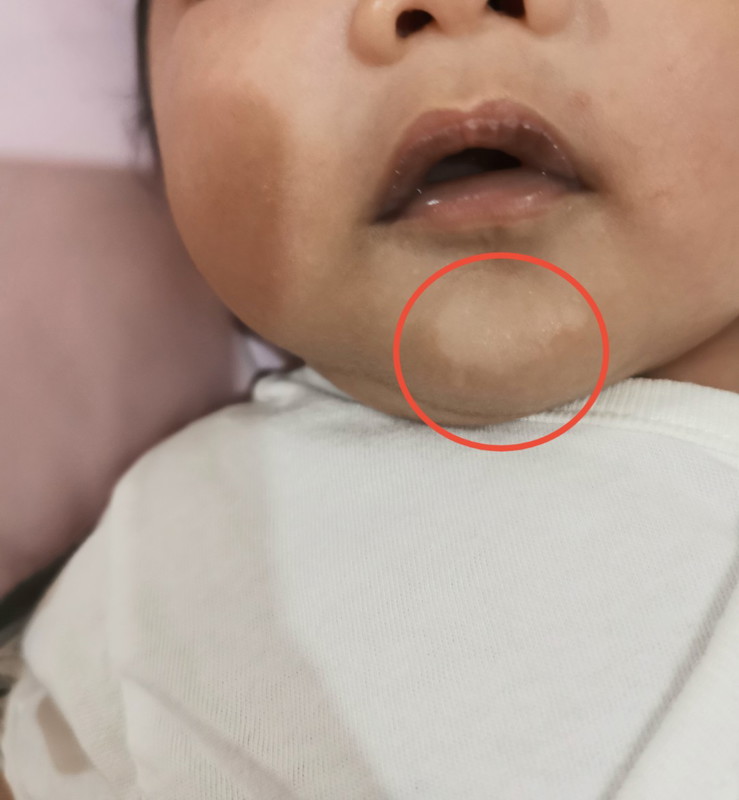 Skin discoloration ni baby