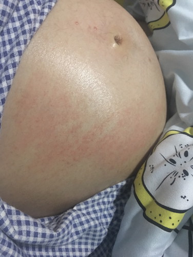 ผื่นคันที่หน้าท้อง