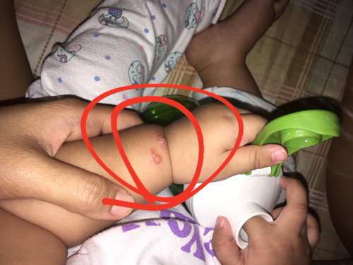 Ant bites