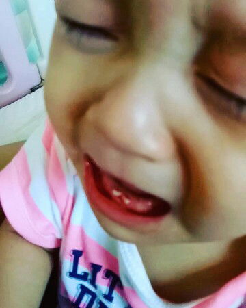 น้องอาเซินในวันที่ปากแตก