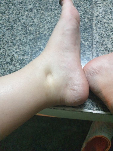 เท้าบวมกดแล้วบุ๋ม 36week 4 day