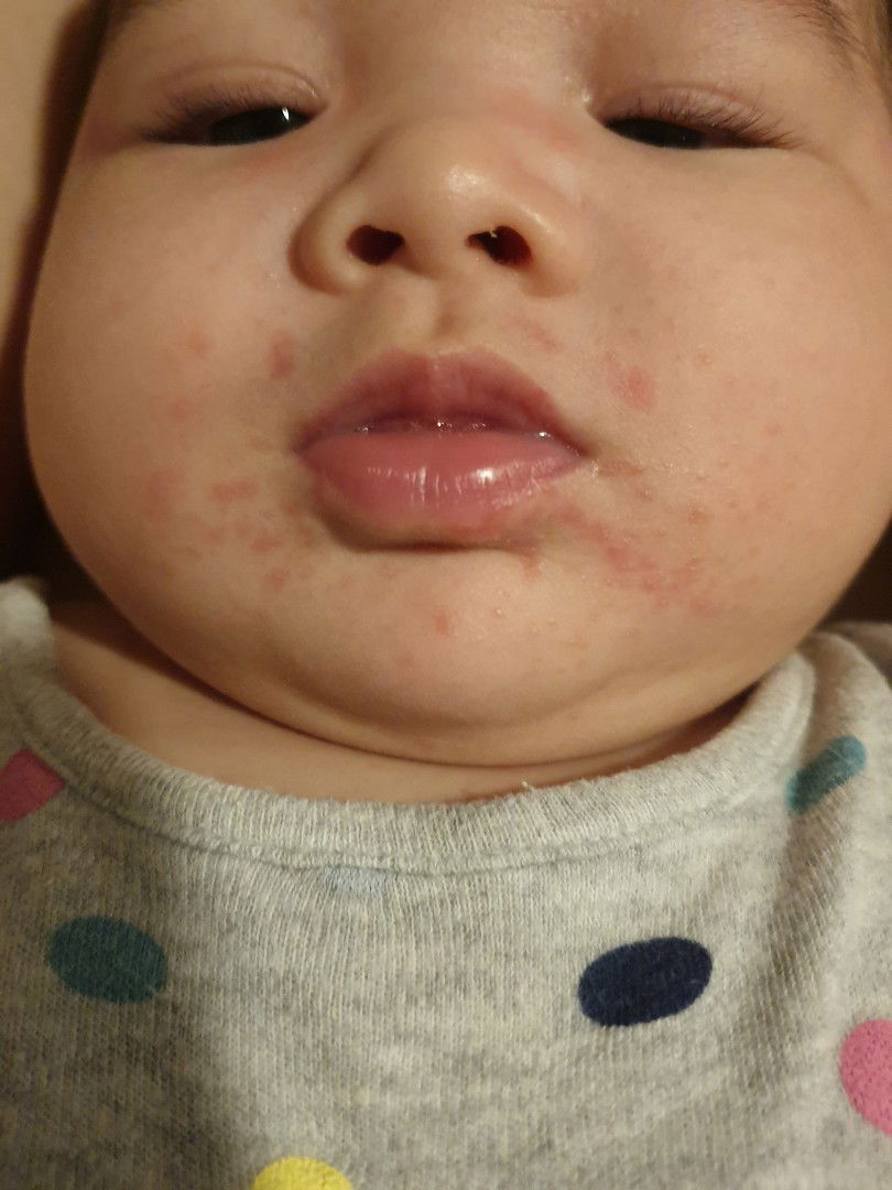 หลังทานอาหารแล้วเป็นผื่นแบบนี้ แพ้อาหารหรือเปล่าค่ะ