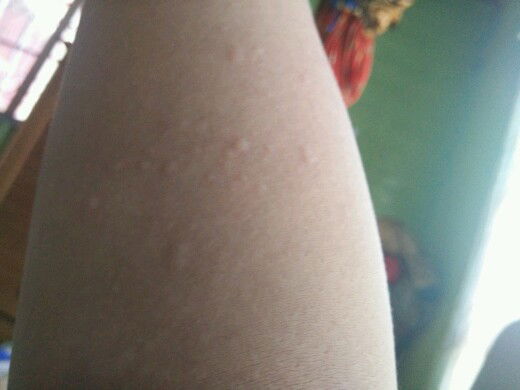 Bentol setelah melahirkan