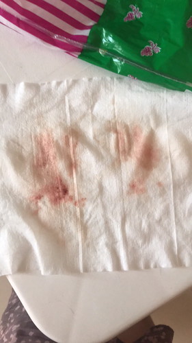Bleeding after IE