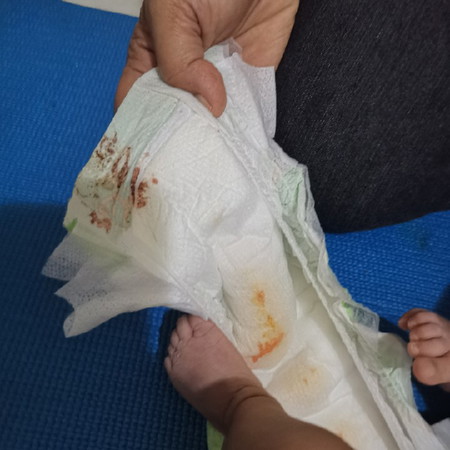 Blood In Newborn Urine, Is It Normal?
