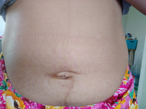 stretchmarks