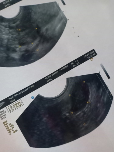 ประจำเดือนขาด 15 วัน ตรวจแล้วขึ้น2ขีด