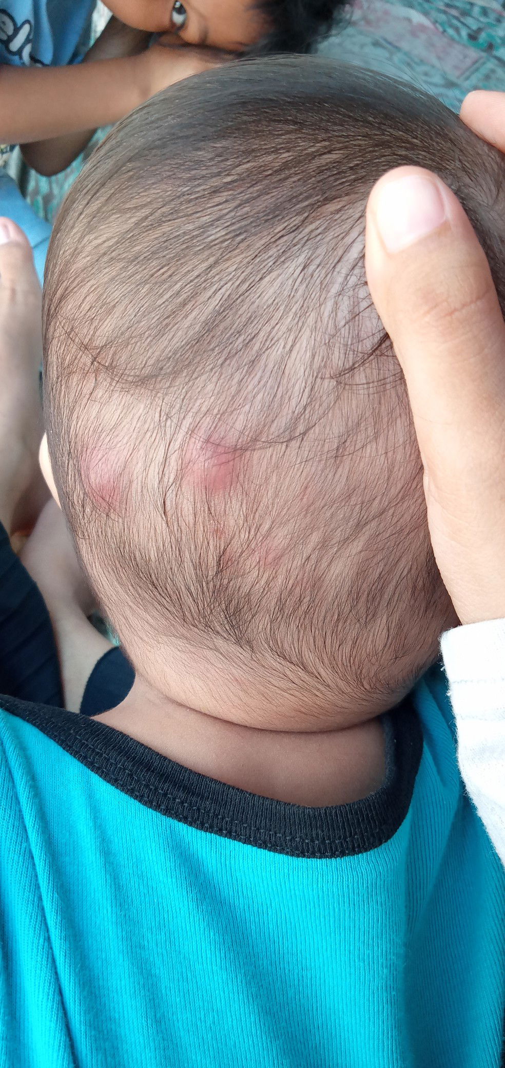 benjolan dikepala bayi