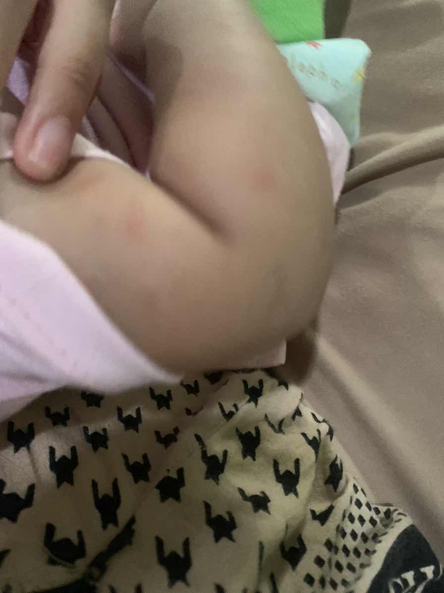 Merah merah pada kulit bayi