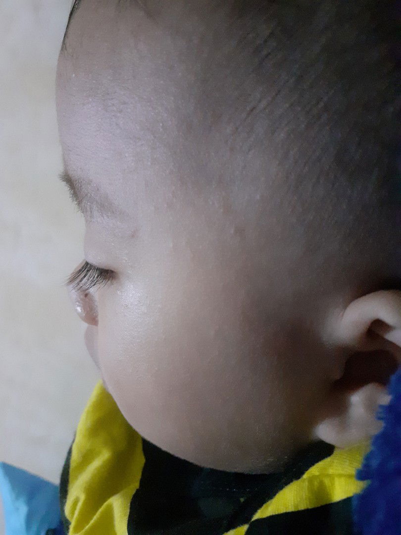bintik merah di muka bayi