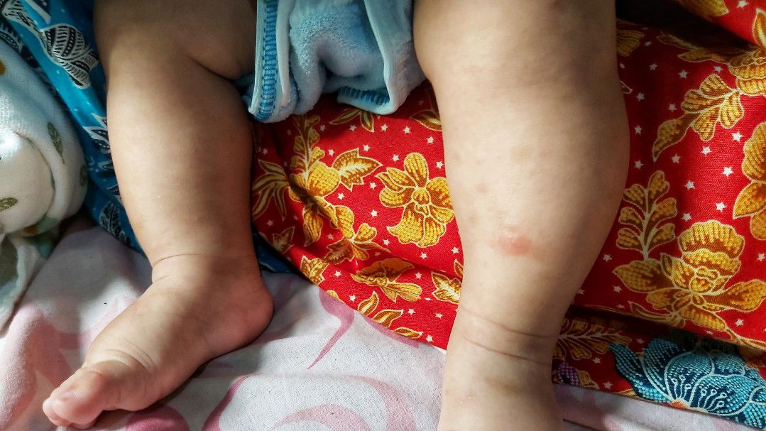 merah di kaki di kasih pure baby rast cream bekas hitam