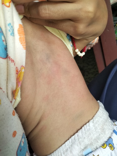 ลูก6 เดือนเป็นตุ่มแดงที่หลัง