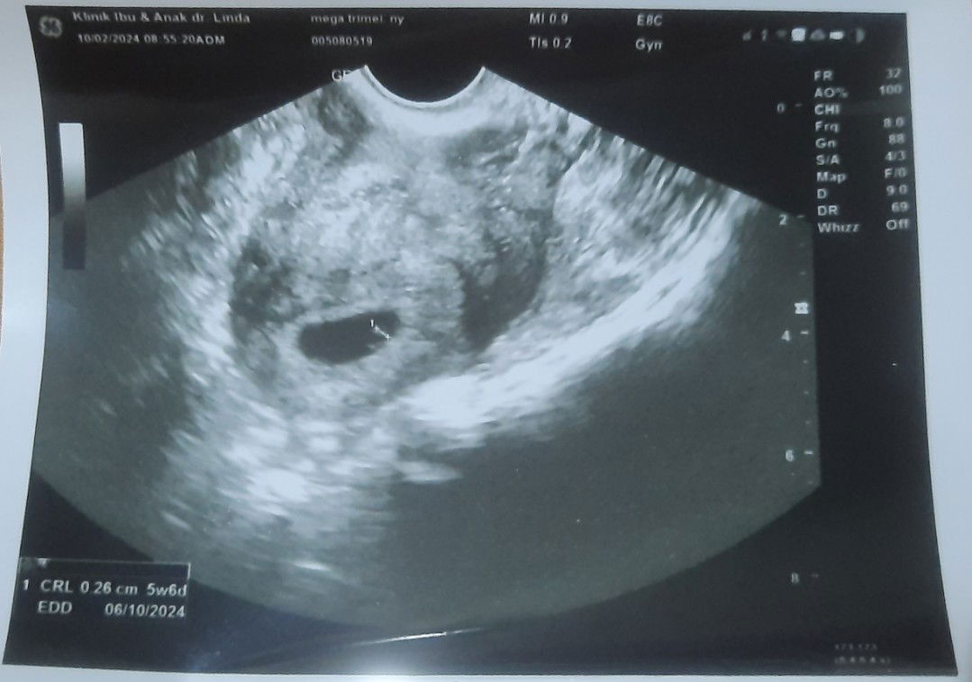 Umur dr hasil usg 2d dan usg transvaginal berbeda
