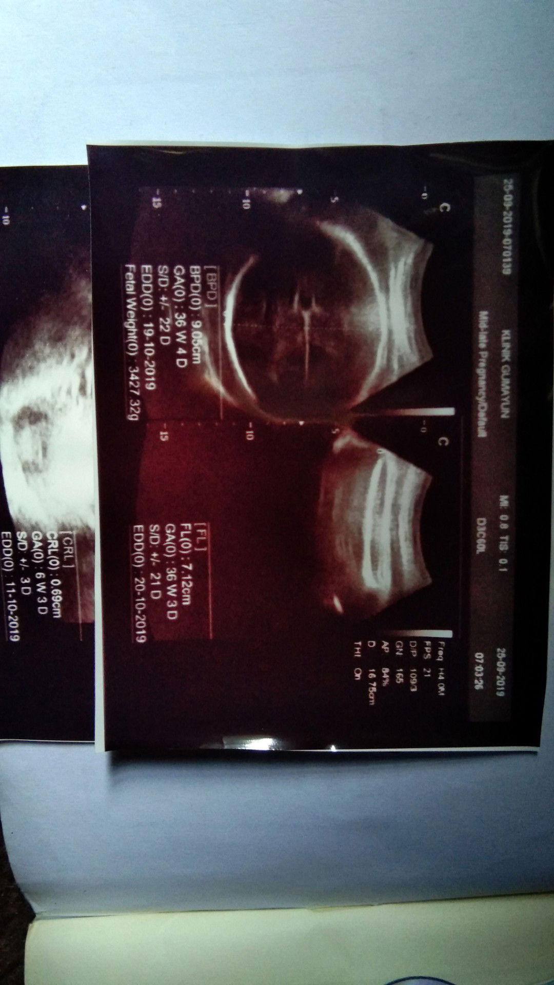 hasil usg yang membingungkan