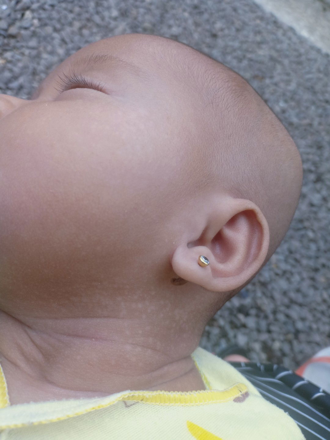 bercak putih di leher