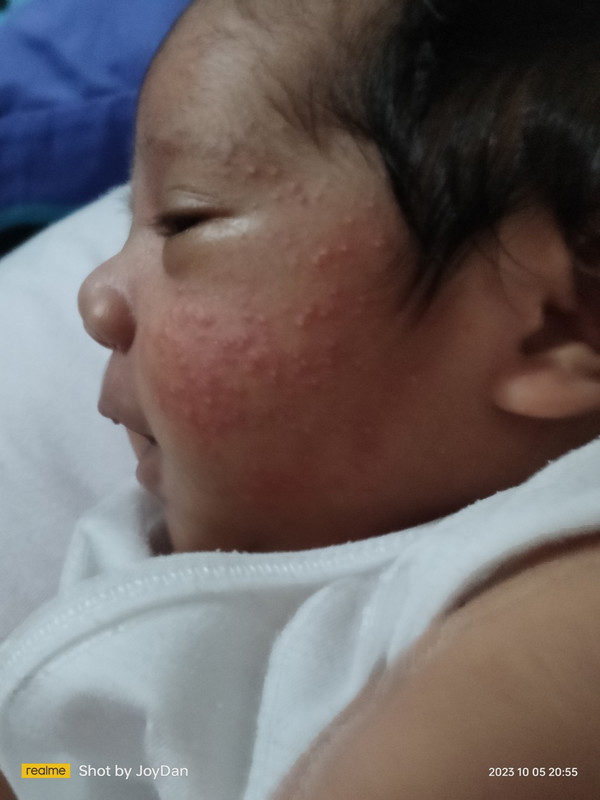 Rashes sa Face ni Baby