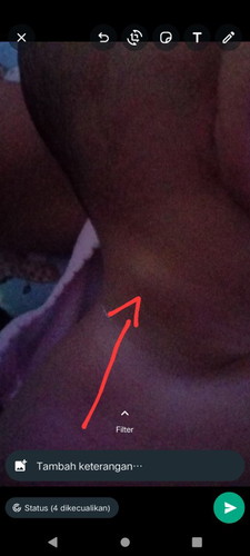 bun mau tanya bayi ku ada benjolan nya di leher itu apa ya bahaya engga