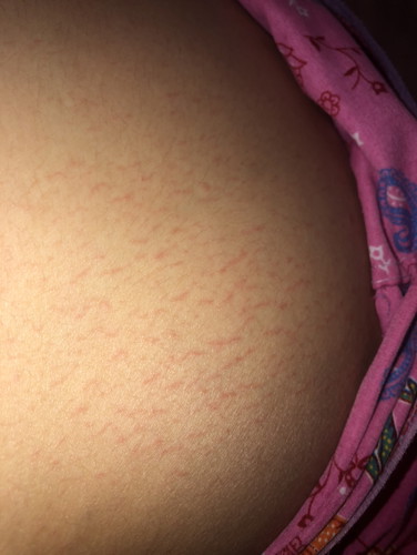 แบบนี้ท้องแตกลายหรือเปล่าค่ะ