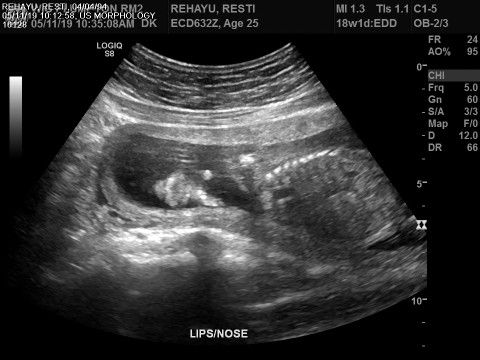 arti palate pada usg.. benarkah sumbing?