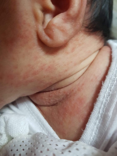 rashes