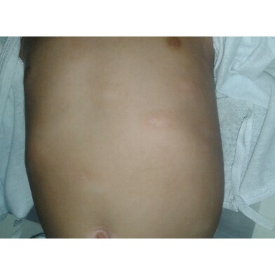 RASHES