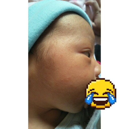 ผื่น