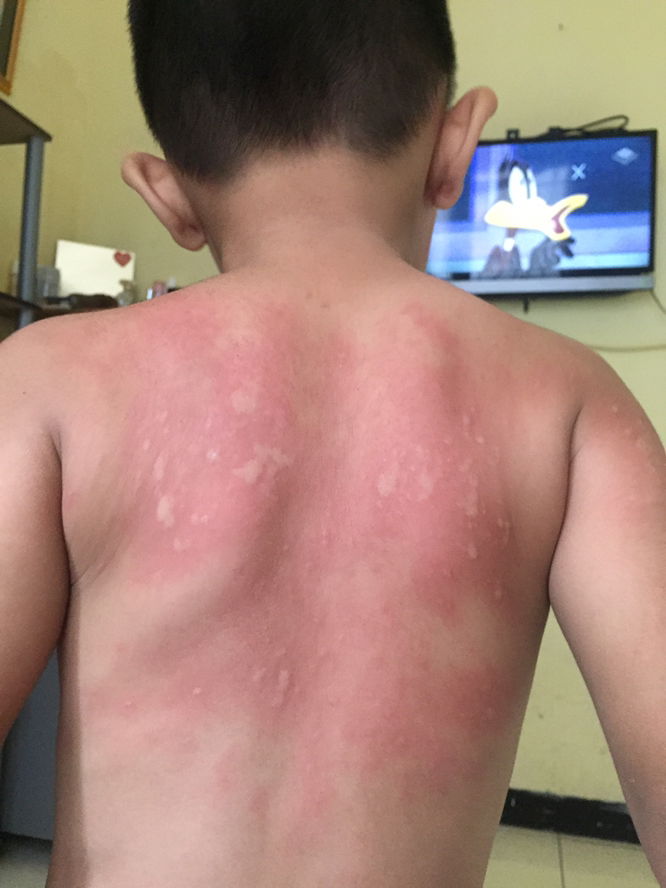 Gatal pada anak berhari hari