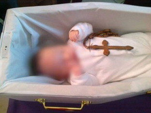 ASPIRATION PNEUMONIA and SIDS