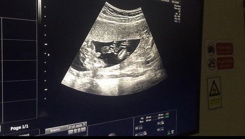 17 Weeks. อัศจรรย์