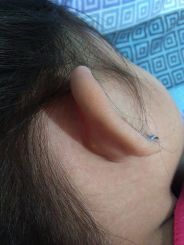 dengue rash