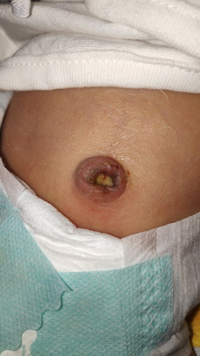 Umbilical cord