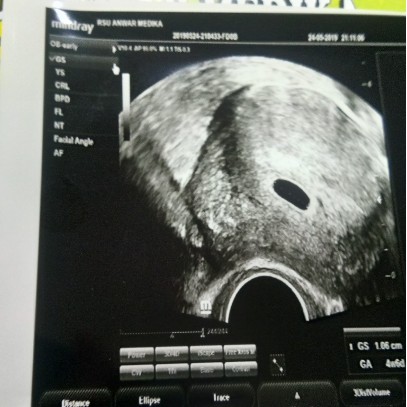 asskum..pagi bunda" sya bru hamil 5w kmren di USG msih terliht kantonya sja semoga kontrol lusa sudah terliht perkmbngan nya dan sehat amiin