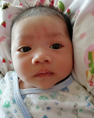 ปานแดงที่หน้าผาก