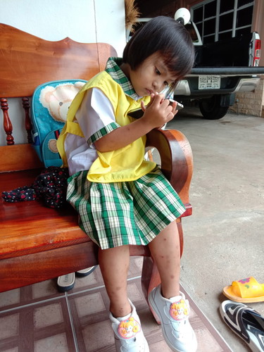 ครีมทาลดรอยจุดด่างดำของเด็ก