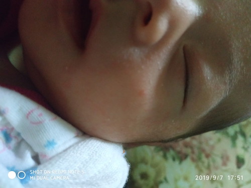 ruam susu &panas vs putih susu dkt lidah