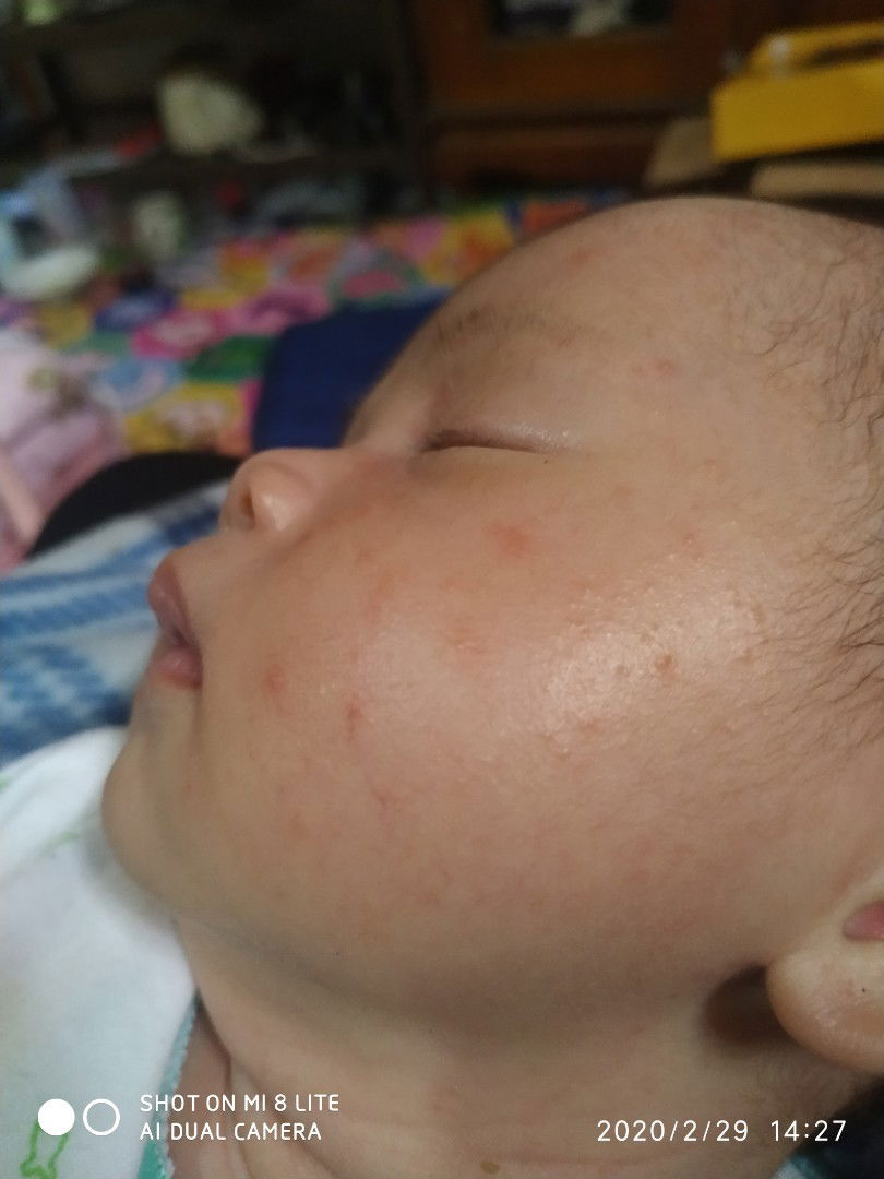 masalah bintik2 merah d muka