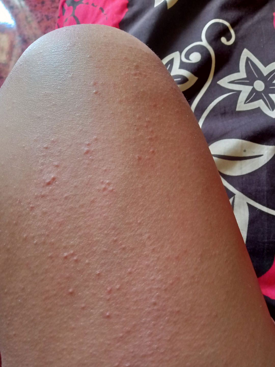 gatal saat hamil 36w