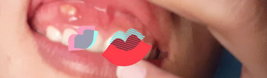 gusi bisul atau sariawan