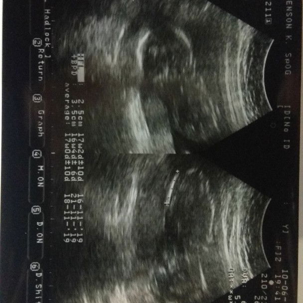 Susah Tidur Wktu Hamil Muda