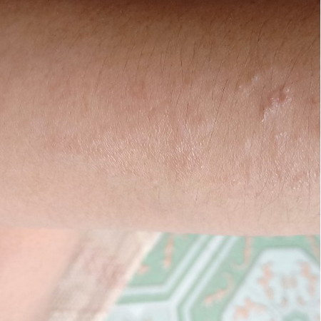 dry skin ..