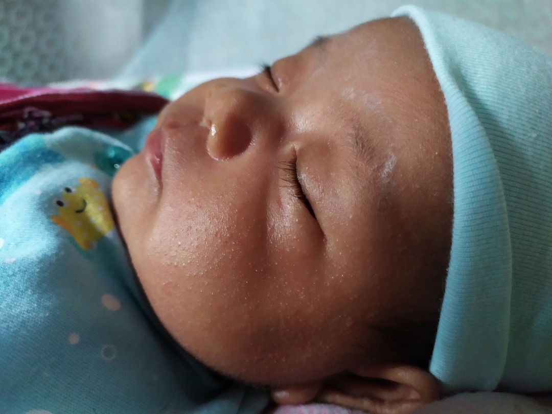 bintik2 kecil di muka