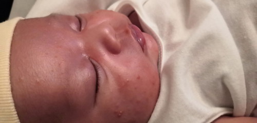 Baby Acne?