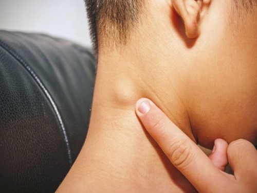 Swollen lymph nodes: Causes, symptoms & diagnosis