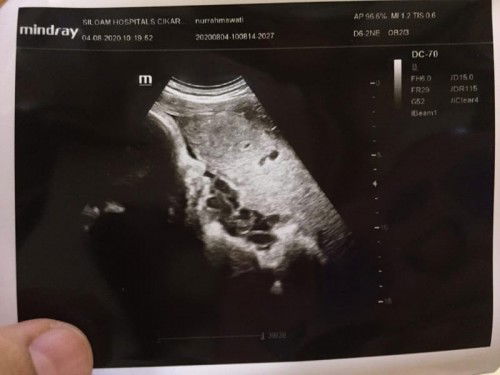 Plasenta posterior bisakah melahirkan normal?