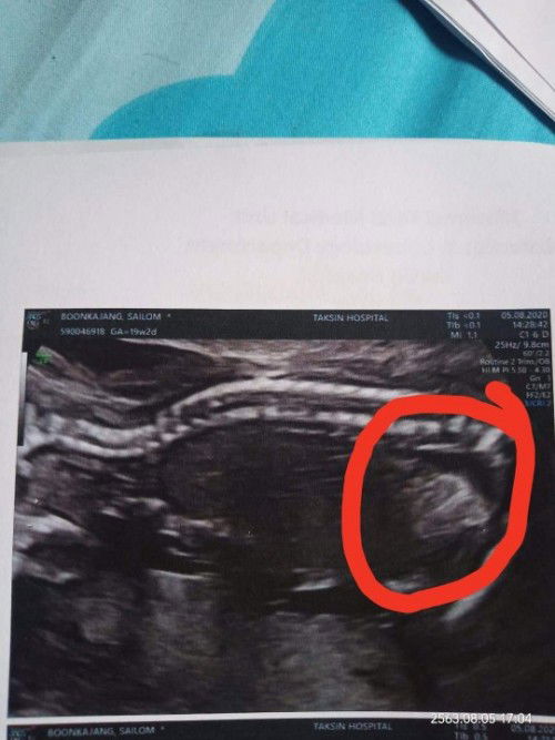 เด็กโครโมโซมเกิน21