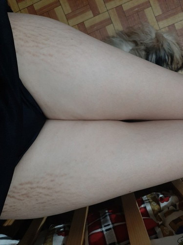 STRETCH MARKS