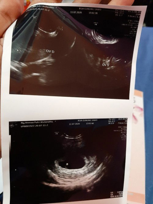 bund sharing yuk, penyebab embrio nggak berkembang tu apa ?